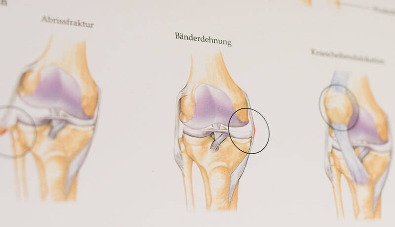 Therapie Muskelschmerzen und Muskelverletzungen
